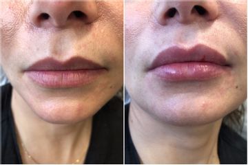 Augmentation des lèvres - Dr Malika Azzam