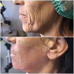 Peeling - Dr Malika Azzam