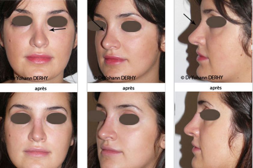 Rhinoplastie médicale avant et après - 543915