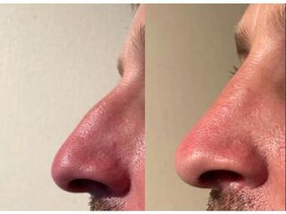 Rhinoplastie - Dr Pierre Laur