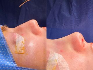 Rhinoplastie - Dr Pierre Laur