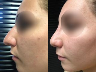 Rhinoplastie médicale - Dr Pierre Laur