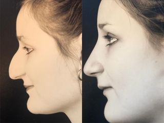 Rhinoplastie - Dr Pierre Laur