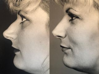 Rhinoplastie - Dr Pierre Laur