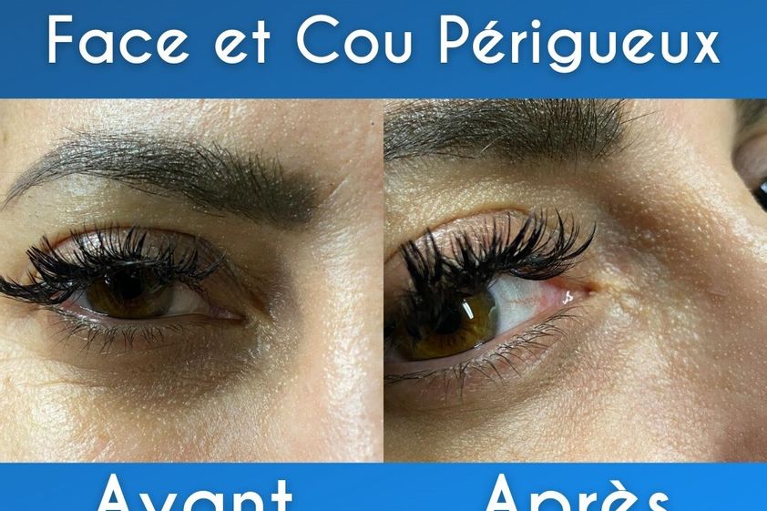 Acide Hyaluronique avant et après - 799641