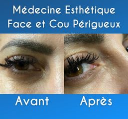 Acide hyaluronique - Dr Pierre Laur