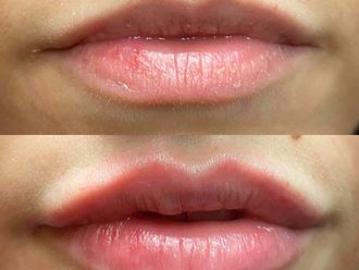 Augmentation des lèvres-799642