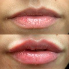 Augmentation des lèvres - Dr Pierre Laur