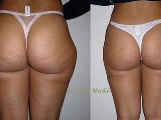 Avant après liposuccion 