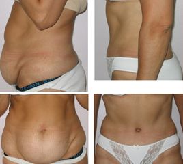 Abdominoplastie - Dr Alireza Alamdari