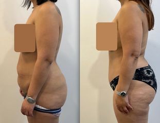 Abdominoplastie - Dr Alireza Alamdari