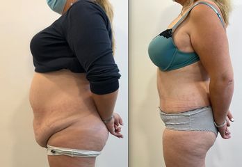 Abdominoplastie - Dr Alireza Alamdari