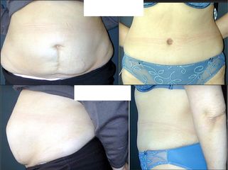 Abdominoplastie - Dr Alireza Alamdari