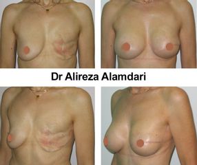 Reconstruction mammaire - Dr Alireza Alamdari