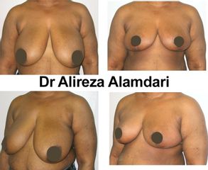 Réduction mammaire - Dr Alireza Alamdari
