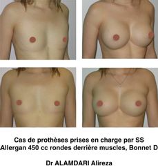Augmentation mammaire - Dr Alireza Alamdari