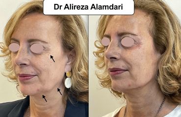Botox - Dr Alireza Alamdari