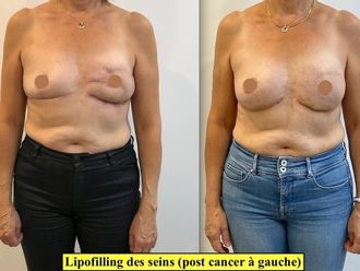 Reconstruction mammaire avant et après - 795611
