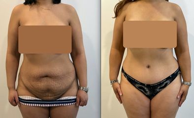 Abdominoplastie - Dr Alireza Alamdari