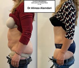 Abdominoplastie - Dr Alireza Alamdari