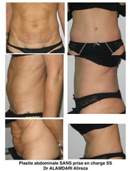 Abdominoplastie - Dr Alireza Alamdari