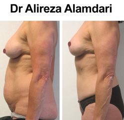 Abdominoplastie - Dr Alireza Alamdari