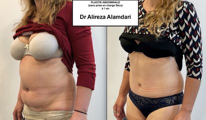 Abdominoplastie - Dr Alireza Alamdari