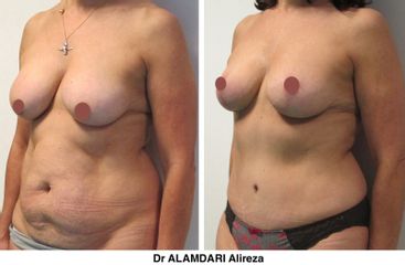 Réduction mammaire - Dr Alireza Alamdari