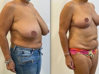 Réduction mammaire - 795628