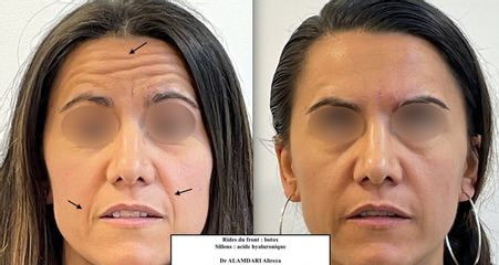 Botox - Dr Alireza Alamdari