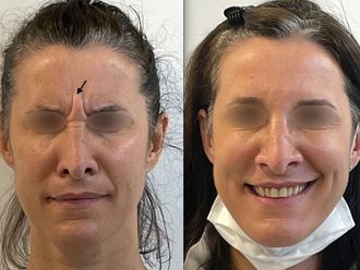 Botox - 795632