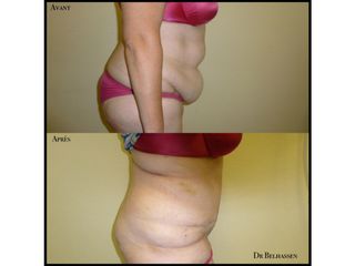 Avant après abdominoplastie