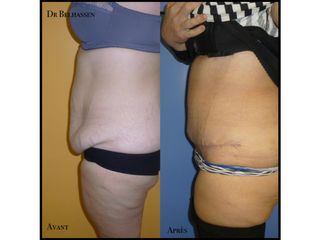 Avant après abdominoplastie