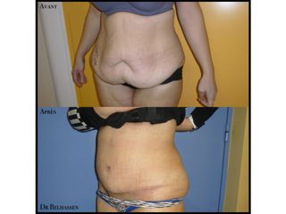 Avant après abdominoplastie