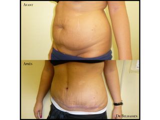 Avant après abdominoplastie