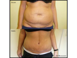Avant après abdominoplastie