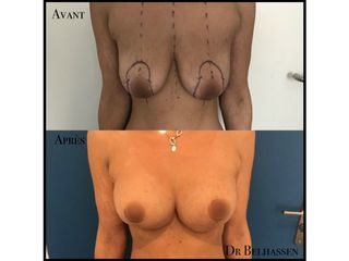 Avant après cure de ptose mammaire