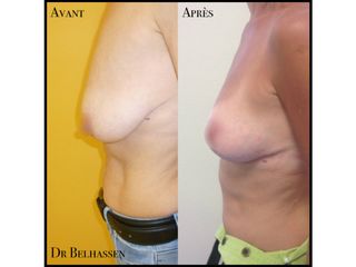 Avant après cure de ptose mammaire