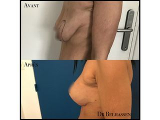 Avant après cure de ptose mammaire