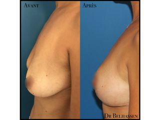 Avant après cure de ptose mammaire