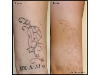 Détatouage - 633149