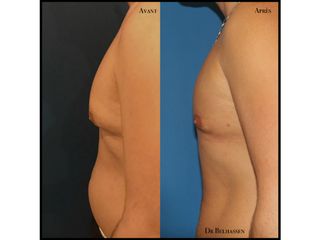 Avant après gynécosmastie + liposuccion abdomen