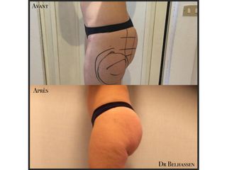 Avant après lipofiling de fesses