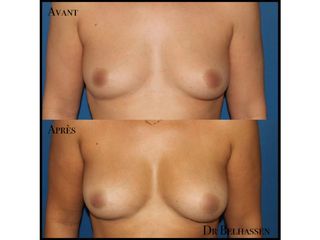 Avant après lipofiling de seins