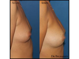 Avant après lipofiling de seins