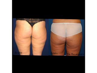 liposuccionAvant après