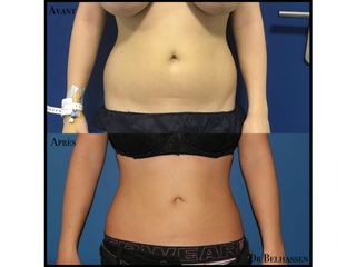 Avant après liposuccion