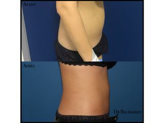 Avant après liposuccion