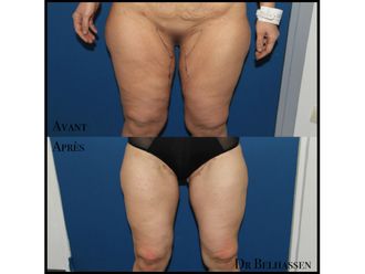 Bodylift avant et après - 633173