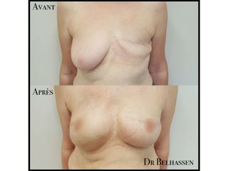 Avant après reconstruction mammaire